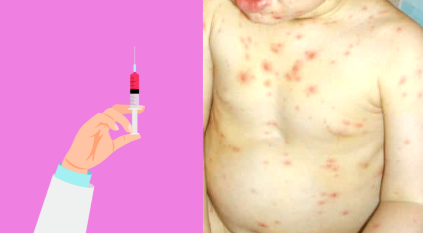 chickenpox vaccine side effects toddler