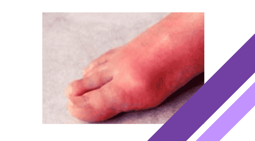 foot infection with diabetes