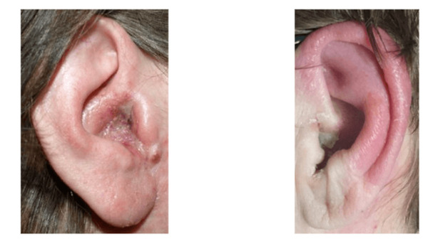 fungal infection in ear