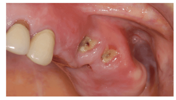 infection in jaw bone from tooth