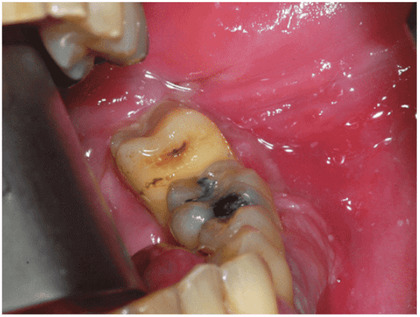 infection in jaw bone from tooth