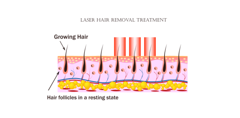 laser hair removal cost in USA