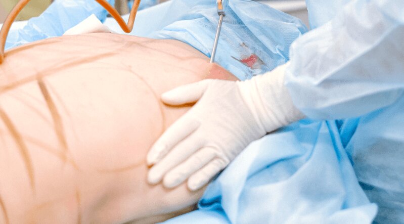 benefits of liposuction