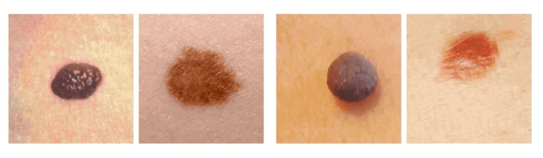 skin cancer moles early stages