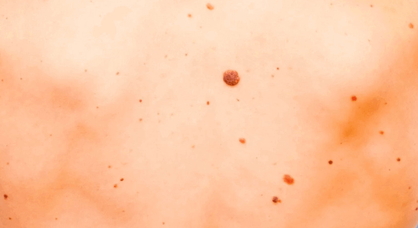 skin cancer moles early stages