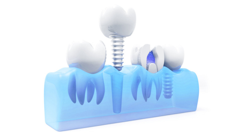 dental implants