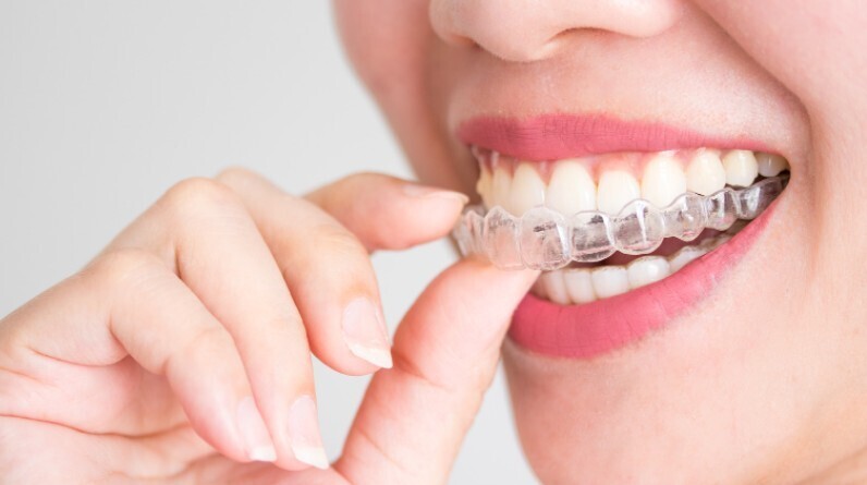 Invisalign Clear Aligners