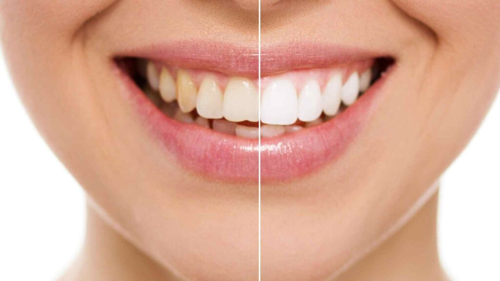 how to remove tartar from teeth without dentist