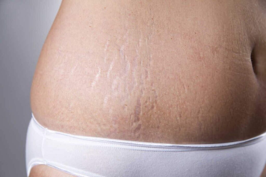 How to Make Stretch Marks Disappear