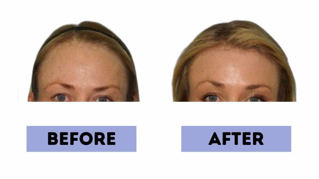 forehead reduction surgery cost